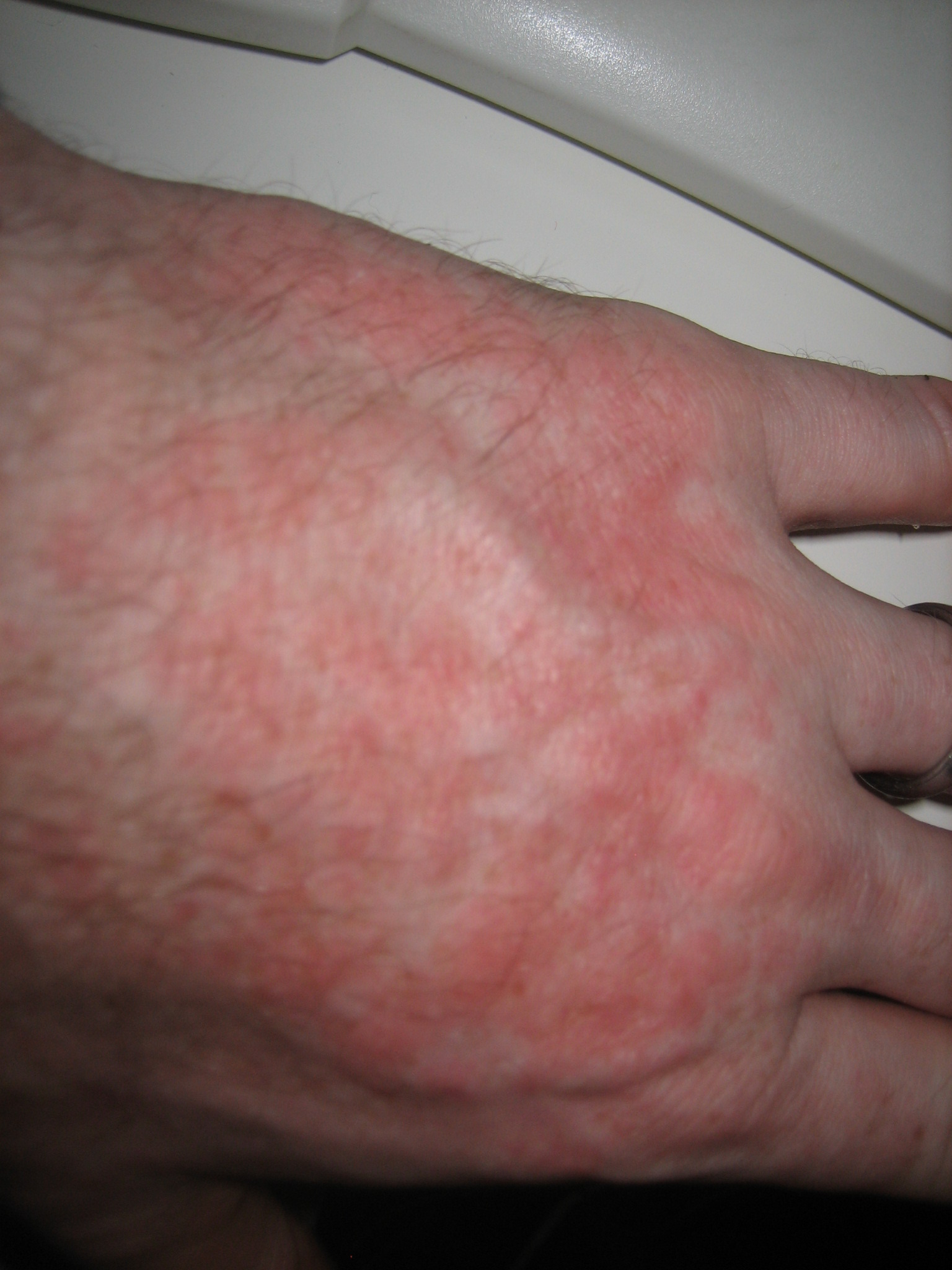 skin rash on hands #9